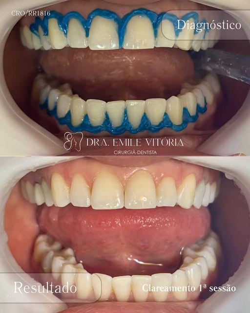 Diagnóstico e resultado de clareamento dental após a primeira sessão, com os dentes visivelmente mais claros