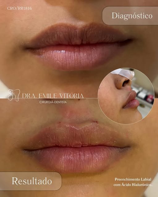 Diagnóstico e resultado de preenchimento labial com ácido hialurônico, com lábios mais definidos e volume sutil