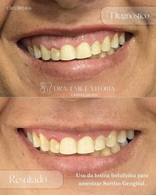 Diagnóstico e resultado do uso de toxina botulínica para suavizar o sorriso gengival, com menor exposição da gengiva